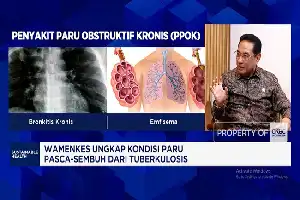 El Ministerio de Salud amplía la escala de detección temprana de la tuberculosis para reducir la carga económica nacional