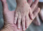 Los casos de sarampión en Indonesia superan los 21 mil, el Ministerio de Salud recuerda la importancia de la inmunización de refuerzo para niños en edad escolar