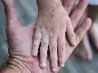 Los casos de sarampión en Indonesia superan los 21 mil, el Ministerio de Salud recuerda la importancia de la inmunización de refuerzo para niños en edad escolar